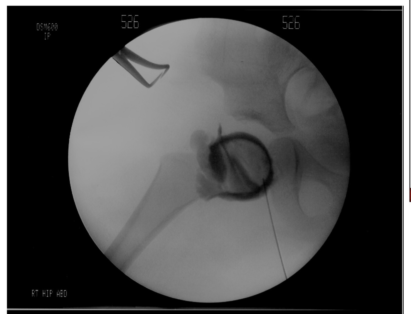 Arthrogram image - arthrogram sign
