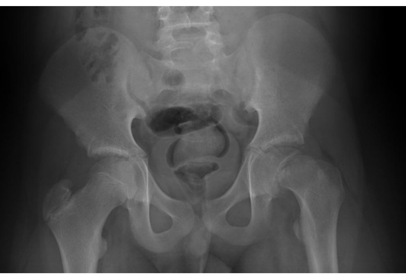 Radiograph / imaging - SCFE radiograph